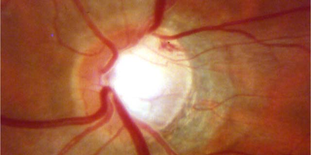 Patologie oculari